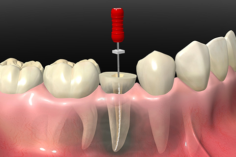 根管治療