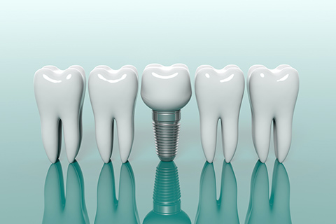 インプラント治療とは