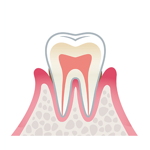 歯周炎(軽度)