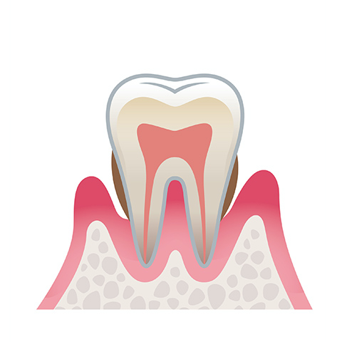 歯周炎(中等度)