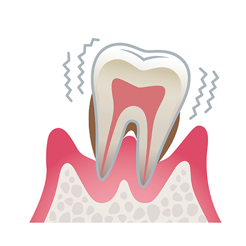 歯周炎(重度)